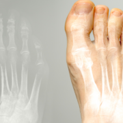 Hallux Valgus Symbolbild